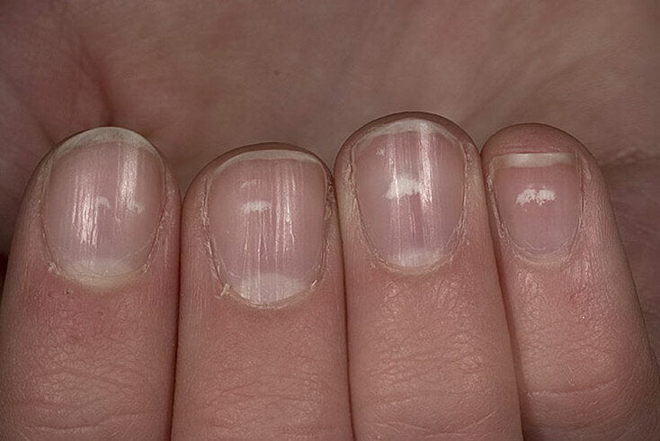 nagelvlekjes.jpg