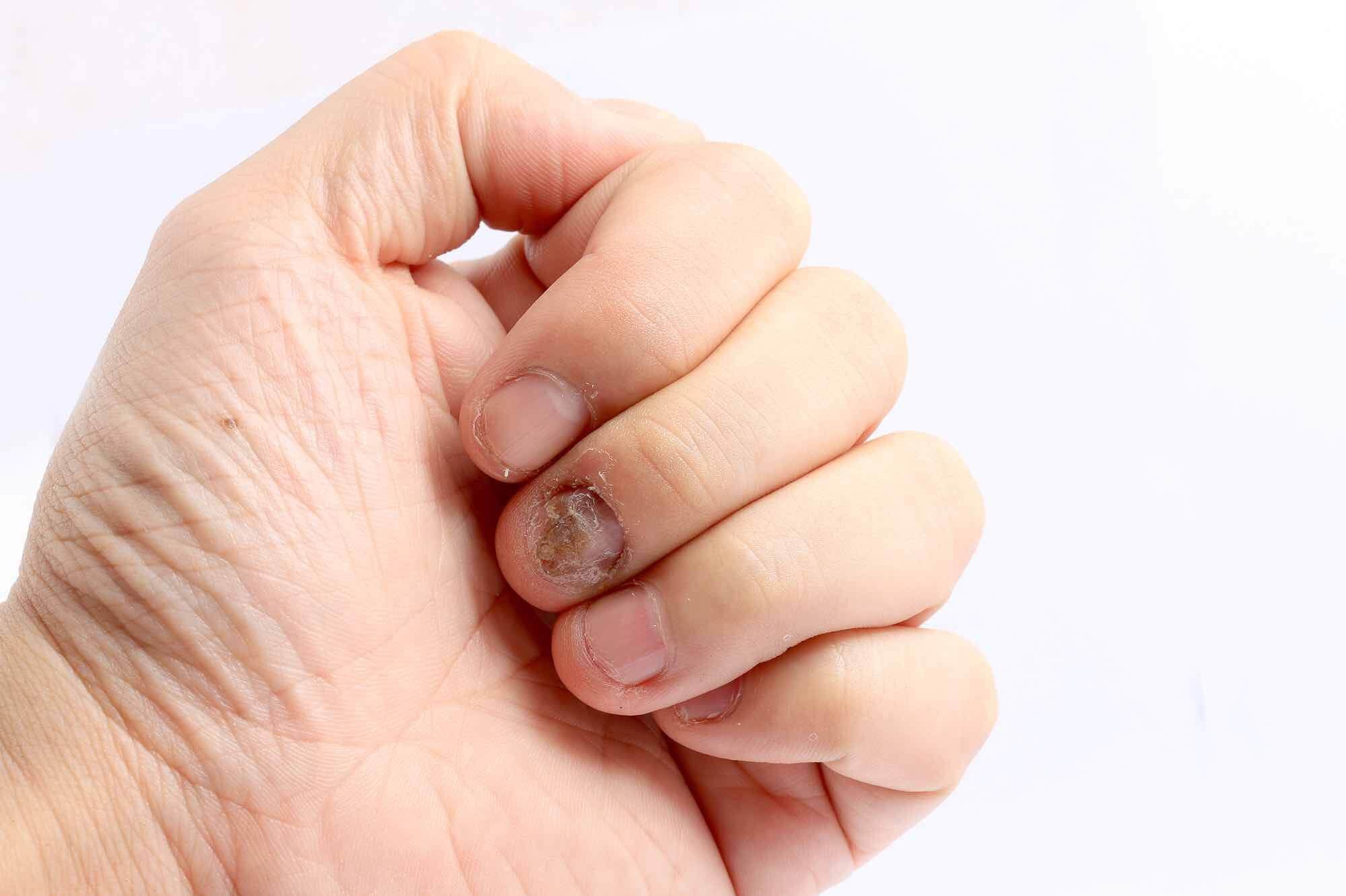 schimmelnagel-vinger.jpg