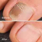 Vorher-Nachher Vergleich mit Flunail® Nagelpflege Stift – sichtbare Verbesserung bei Nagelpilz, gesunde und glatte Nägel nach der Anwendung